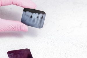 Înlocuirea dinților pierduți cu implanturi dentare