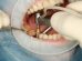 remedii abces dentar
