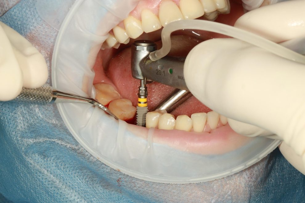 remedii abces dentar